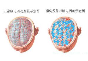 治疗癫痫使用什么仪器?